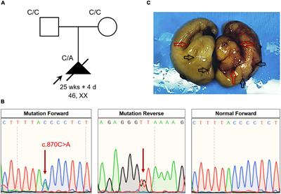 A de novo Non-sense Nuclear Factor I B Mutation (p.Tyr290*) Is Responsible for Brain Malformation and Lung Lobulation Defects